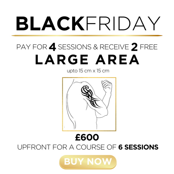 o) Tattoo Removal - Large Area - 2 Sessions FREE!