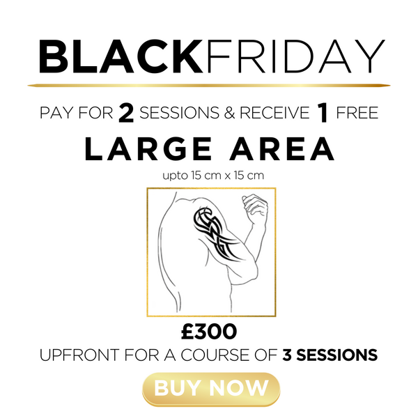 r) Tattoo Removal - Large Area - 1 Session FREE!