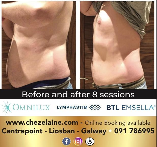 Laser Lipo 3 sessions for €149